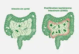 Le Sibo, cette maladie intestinale encore méconnue - Blog d'Angélique