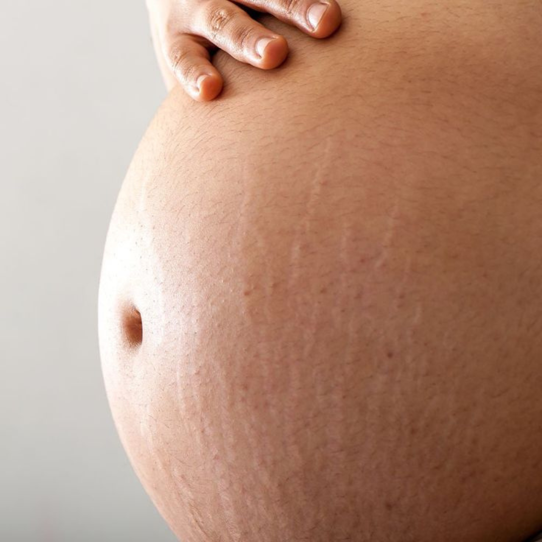 Huiles végétales pour les vergetures : grossesse et post partum