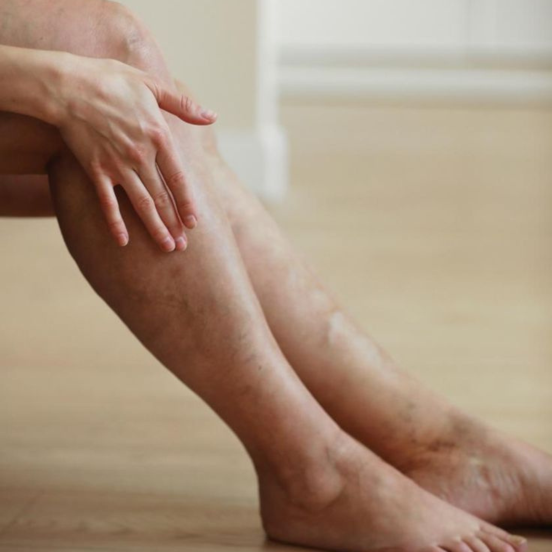 Huiles essentielles et jambes lourdes : retrouver une sensation de légèreté pendant l'été