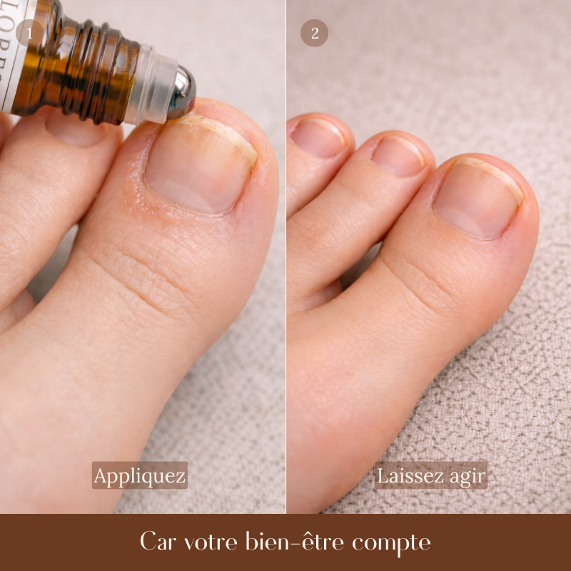 MYCOSE - Mélange d'Huiles essentielles- Roll-on - 10 ML (Ongles, pieds)