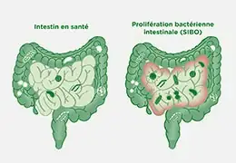 Le Sibo, cette maladie intestinale encore méconnue - Blog d'Angélique