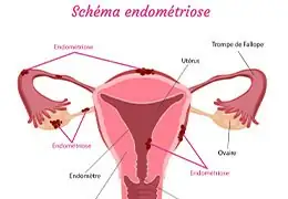 Des règles Douloureuses à  l’Endodométriose - Blog d'Angélique